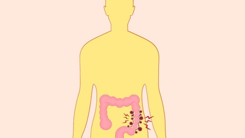 Triệu Chứng Và Biểu Hiện Của Viêm Túi Thừa Đại Tràng
