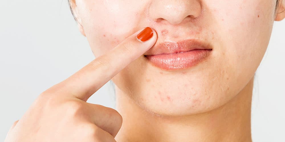 (Q&A) NGUYÊN NHÂN GÂY RA MỤN TRỨNG CÁ Ở NGƯỜI TRƯỞNG THÀNH