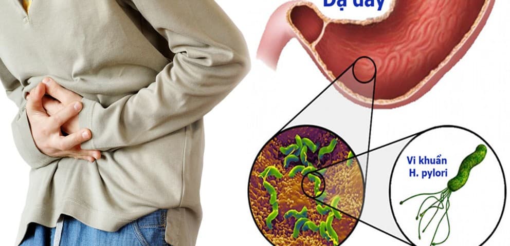Biến Chứng Nguy Hiểm Khi Nhiễm Vi Khuẩn Helicobacter pylori (HP)