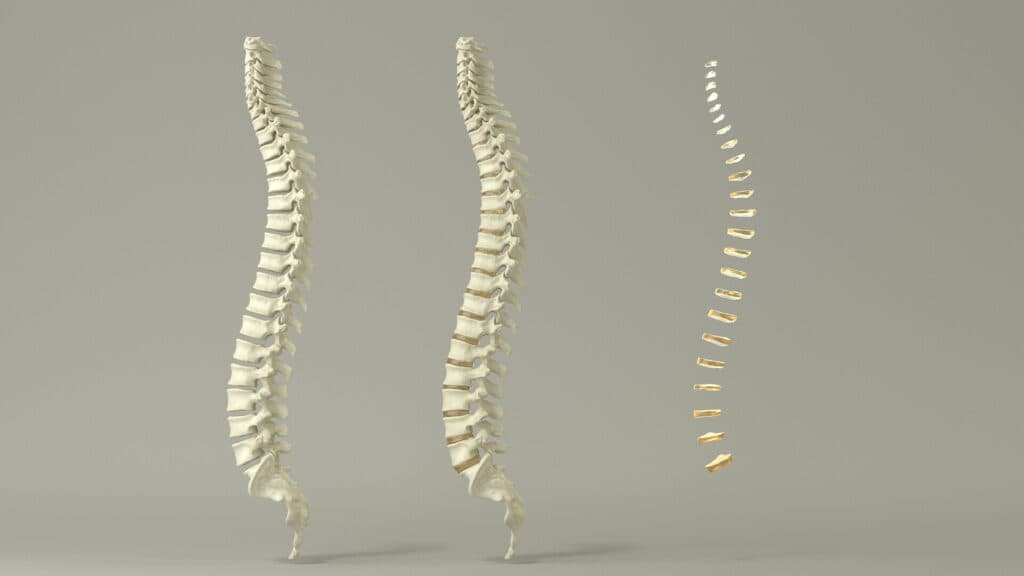 Xử Lý Vấn Đề Vẹo Cột Sống Một Cách Hiệu Quả