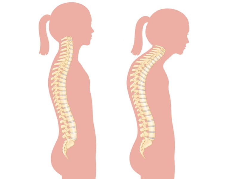 Điều Chỉnh Tư Thế: Biện Pháp Quan Trọng Trong Phòng Ngừa Và Điều Trị Cổ Rùa